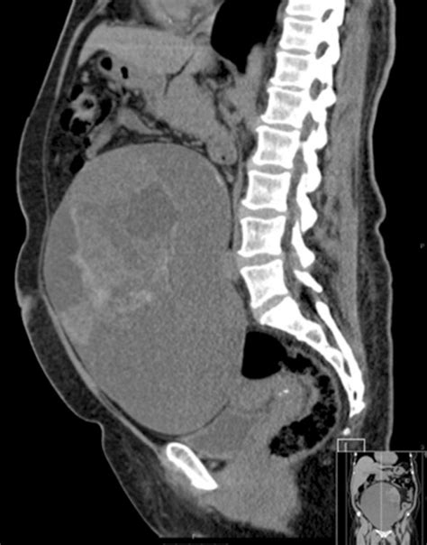 Sagittal Ct Scan Abdomen Labeled Images And Photos Finder
