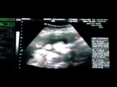 Al cumplir las 22 semanas de embarazo tu bebé desarrolla un importante área cerebral relacionada con las emociones. Bebe mexendo barriga Ultra-som 22 semanas de gestação ...