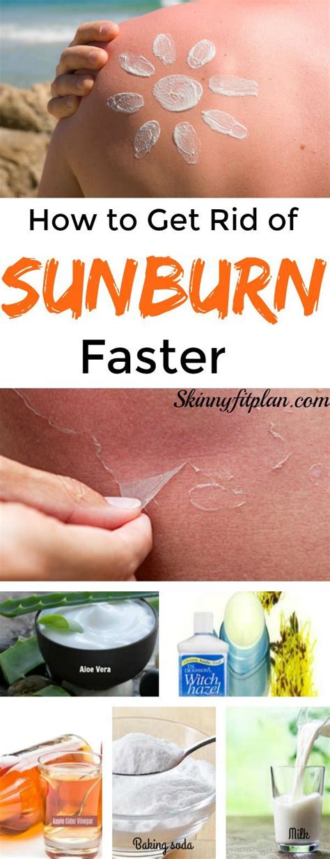 How To Get Rid Of Sunburn Faster10 Best Home Remedies Home Remedies