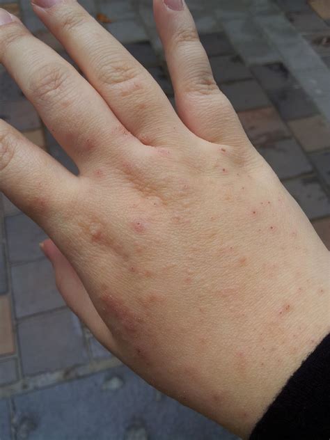 The Random World Of Everbluec Eczema Hives Allergies And Ugly Skin