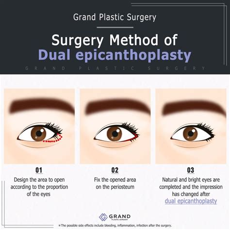 Slanted Eyes Can Make Your Eyes Seem Fierce And Somewhat Unhappy Dual Epicanthoplasty Will