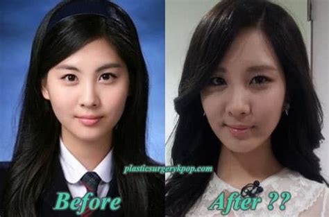 Girls Generation Members Before And After Plastic Surgery