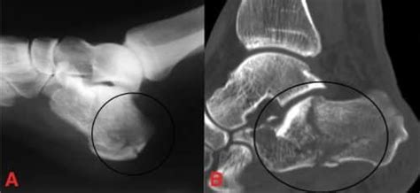 Calcaneal Fracture Teachmesurgery