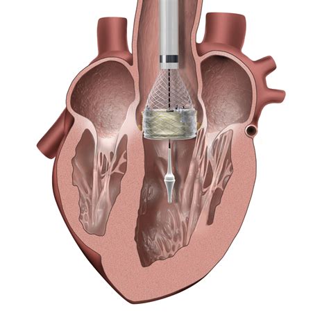 How Tavr Devices Work Transcatheter Aortic Valve Replacement Tavr