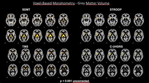 Correlation Between Structural Neuroimaging And Clinical Outcomes In A