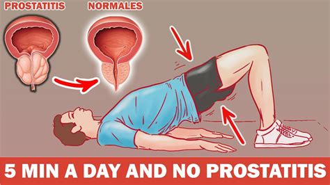 Kegel Exercises For Prostate Problems Best Exercises For Enlarged PROSTATITIS YouTube