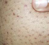 Pictures of Blackheads On Thighs Home Remedies