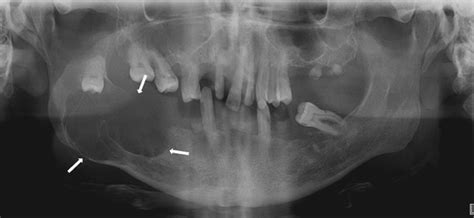 Jaw Lesions Associated With Impacted Tooth A Radiographic Diagnostic Guide