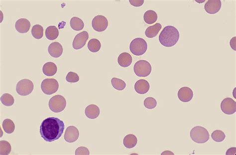 The severity of resultant haemolysis is related to the type and amount of membrane disruption. Hereditary Spherocytosis. Causes, symptoms, treatment Hereditary Spherocytosis