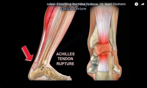 Achilles Tendon Anatomy Diagram