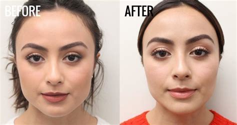 It might be helpful, then. Botox For Jawline: Instant Face Slimming With Botox Injections