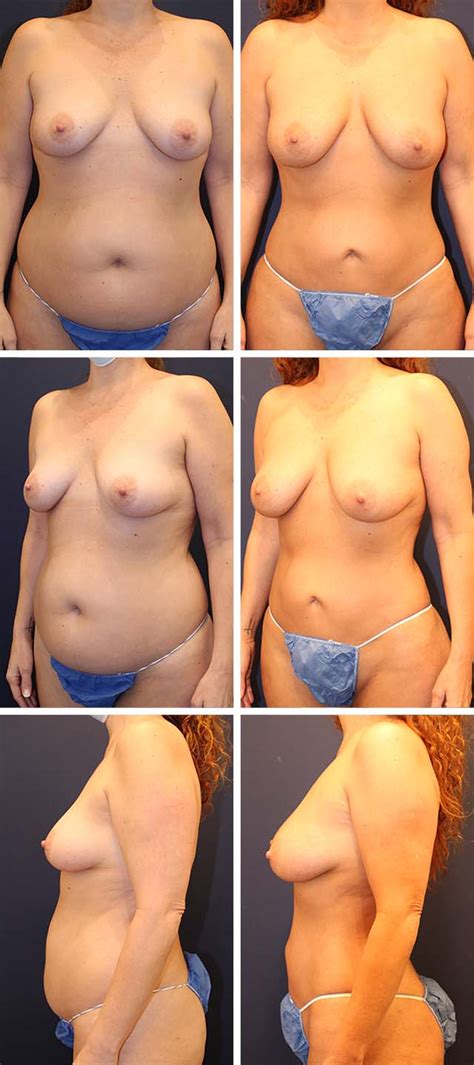 Breast Fat Transfer Before Afters Dr Shermak