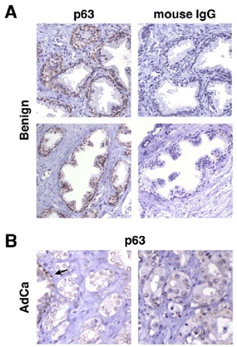 P Expression In Benign And Malignant Prostate P Immunostaining Was Download Scientific
