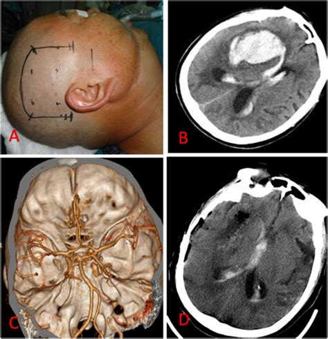 The Basal Ganglia Hematoma Was Evacuated By Transcortical Transtemporal