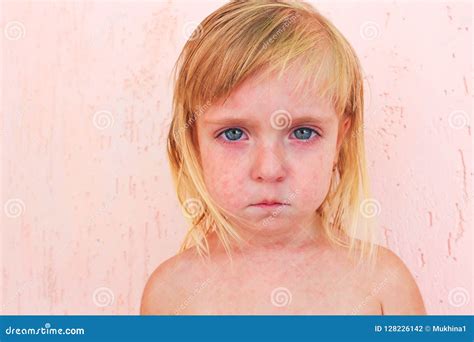 Rash In Child With Roseola Stock Photo Image Of Body Exanthema