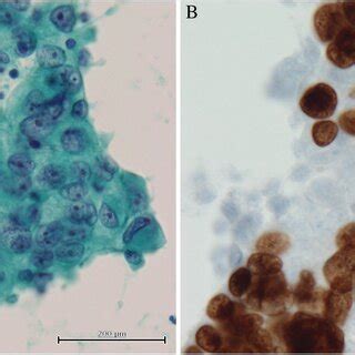 Cytological Findings Of Pleural Fluid A Tumour Cells Forming