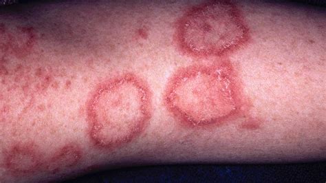 How To Identify Rashes And Other Lupus Skin Symptoms
