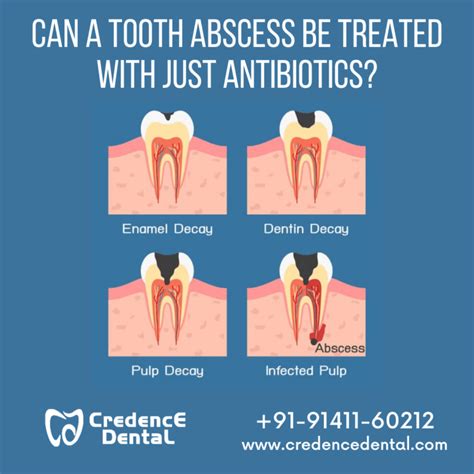 Tooth Abscess Treatment At Home Review Home Co