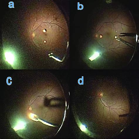 Intraoperative Pars Plana Vitrectomy Steps Showing A Intraocular