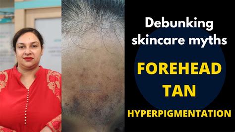 How To Get Rid Of Hyperpigmentationforehead Tan Dark Spots