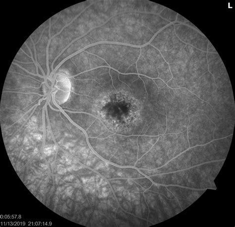 Focal Retinitis Unilateral Acute Idiopathic Maculopathy Os Retina