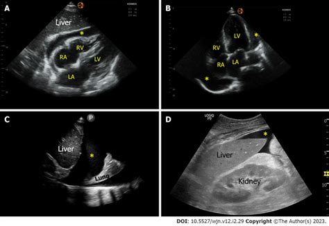 Sonographic Images Demonstrating Various Effusions A And B