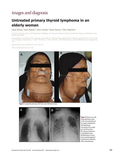 Pdf Untreated Primary Thyroid Lymphoma In An Elderly Woman
