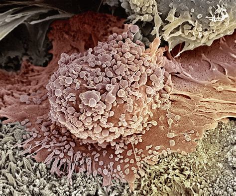 Bone Cancer Cell Sem Photograph By Steve Gschmeissner