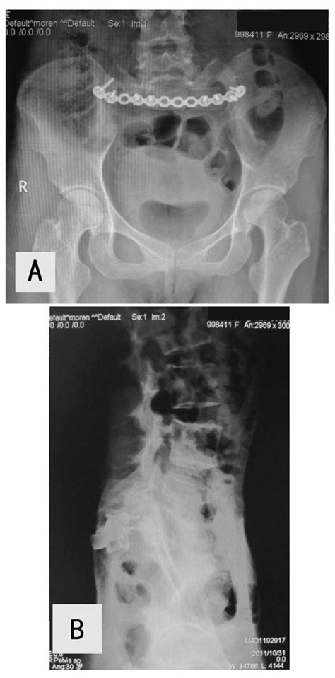 Plain X Ray Of The A Pelvic And B Sacroiliac Regions Six Months