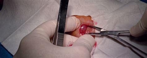 Pediatric Excision Of Ganglion Cyst From Right Wrist Journal Of