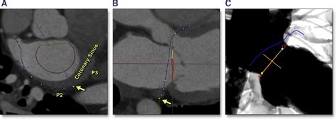 Multimodality Imaging In The Context Of Transcatheter Mitral Valve