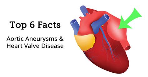 Top 6 Facts About Aortic Aneurysms And Heart Valve Disease