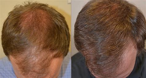 Hair loss occurs when the volume of hair over your head decreases due to reduced growth of hair. Propecia before and after photos - Dr Rogers - New Orleans