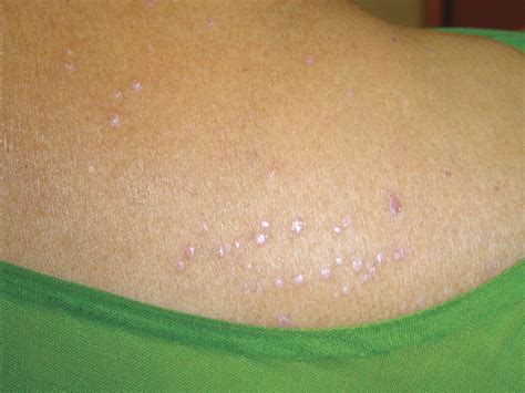 Cutaneous Lesions And Vitamin B Deficiency The College Of Family Physicians Of Canada