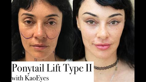 Ponytail Lift Type Ii With Kaoeyes Kao Plastic Surgery Facelift