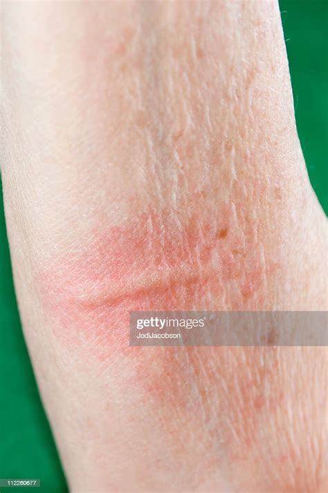 Skin Welt Or Rash High Res Stock Photo Getty Images