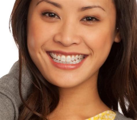 Ceramic Braces Billericay Orthodontics