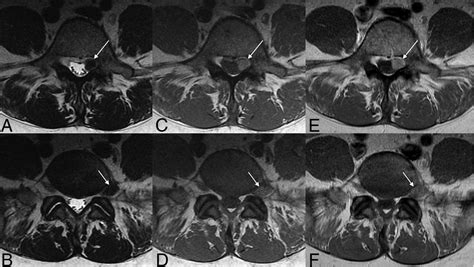 Malignant Melanotic Nerve Sheath Tumor American Journal Of Neuroradiology