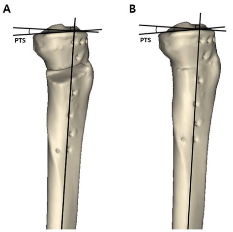 Jcm Free Full Text Effect Of The Osteotomy Inclination Angle In The