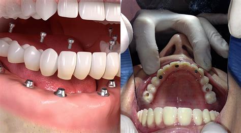 Il tuo problema sono i denti mancanti? Noi abbiamo la soluzione adatta a te