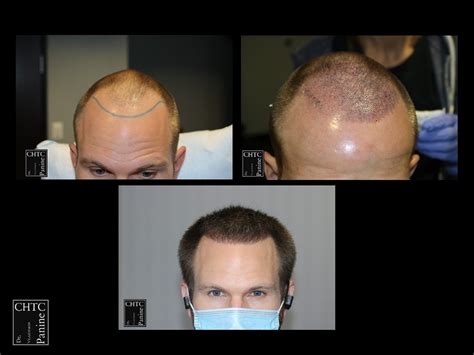 Panine Md Chicago Hair Transplant Clinic Fue Hair Transplant