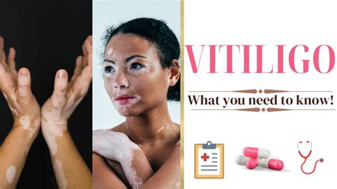 Vitiligo This Is Why You Have It And All You Need To Know Vitiligo