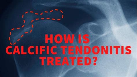 How Is Calcific Tendonitis Treated YouTube