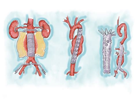 Different Types Of Aneurysms Call For Different Types Of Repairs What