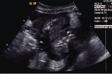 Ultrasonographic Image Of The Caudal Abdomen Showing Ascites Thickened