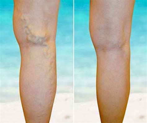 When Varicose Veins Become A Concern Alberta Filipino Journal