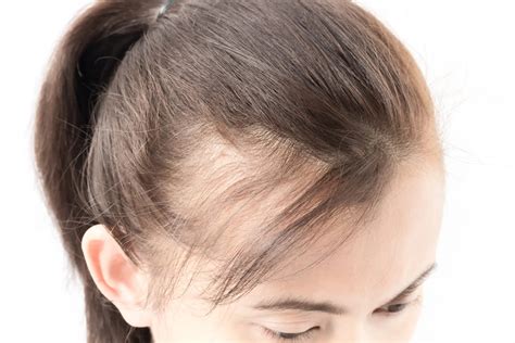 Hair Loss In Women Causes And Treatment Evexias Health Solutions