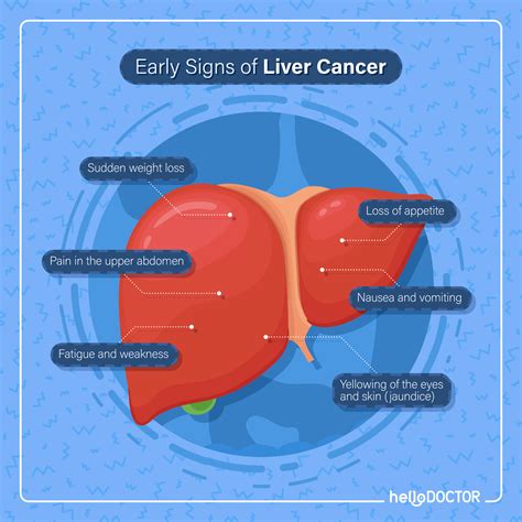 What Happens In Liver Cancer All You Need To Know Hello Doctor