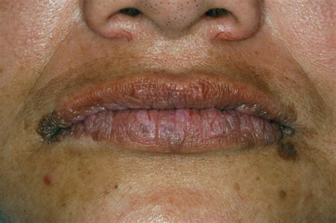 Diagnostic Information Multiple Bumps On Lips And Tongue