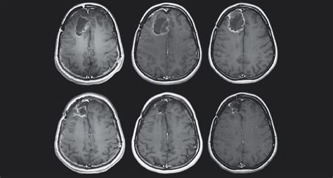 As the tumor grows, it creates pressure on primary brain tumors begin when normal cells acquire errors (mutations) in their dna. Poliovirus treatment helped patients with deadly brain ...